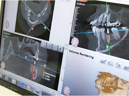 歯科用CT(コンピューター断層撮影)
